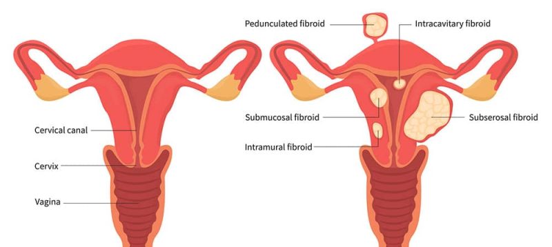 فیبروم رحم چیست؟ علائم، علل و جدیدترین روش‌های درمان